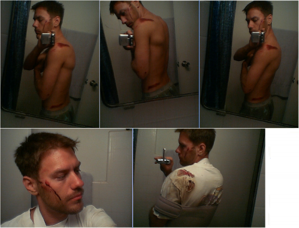 Broken collarbone
