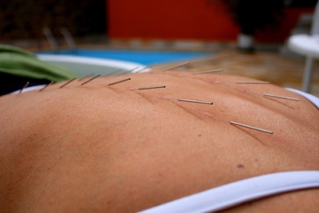 acupuncture